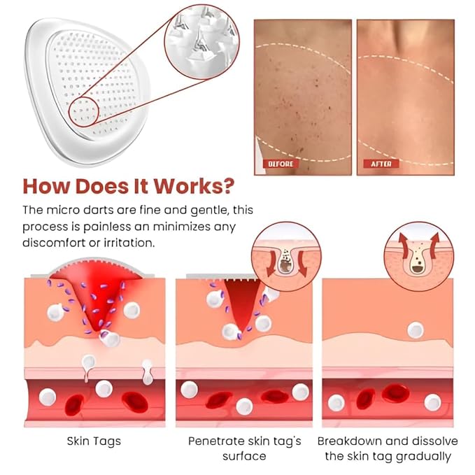 DermaSmooth Skin Tag Remover Patch (Pack of 2)