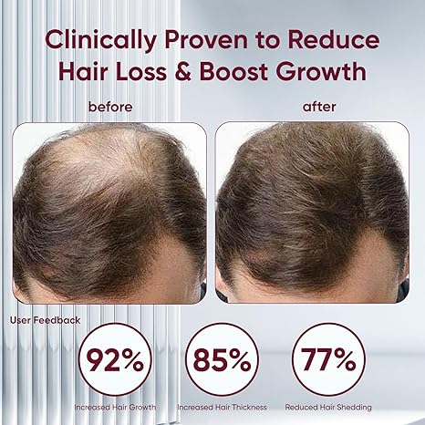 Excalvo Shampoo with Rosemary Oil & Red Onion & Cinnamon Extract, Rosemary Shampoo Strengthens Hair &stops hairloss